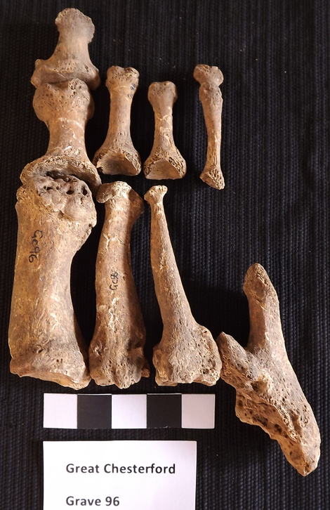 Skeletal remains from Great Chesterford showing evidence of leprosy. This is the oldest known case of leprosy in the UK.